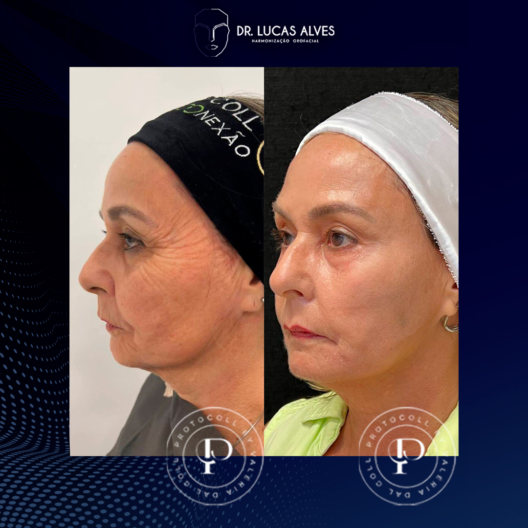 03 antes e depois